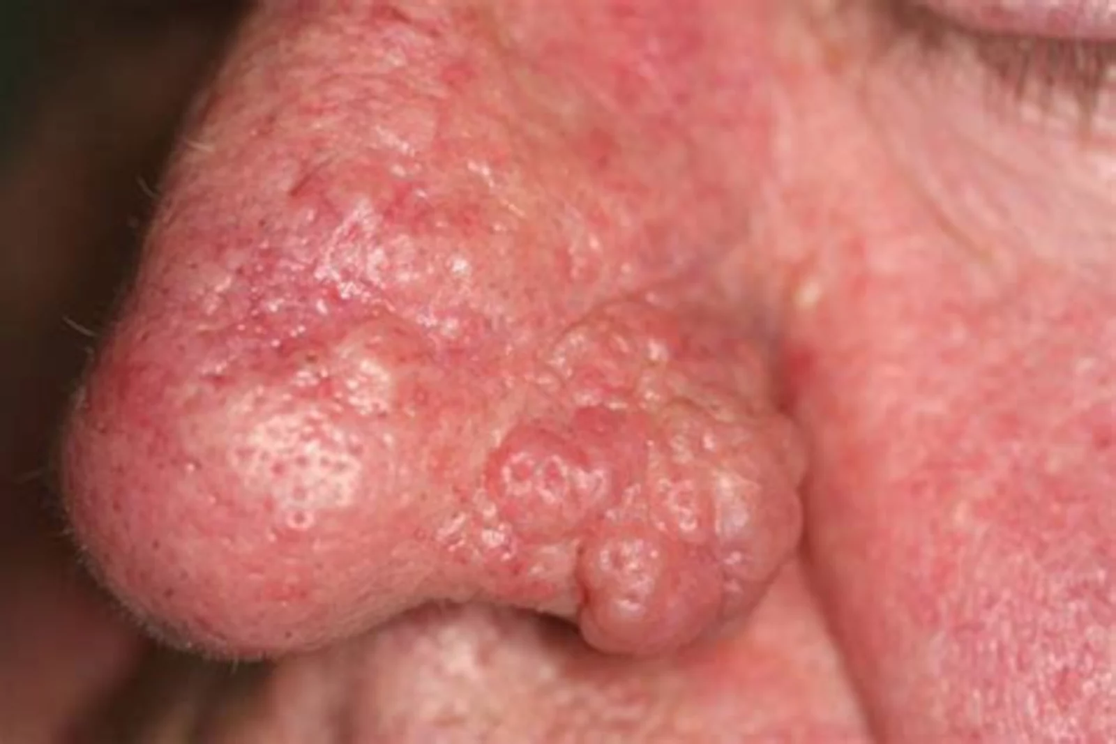 Demodex in the nose