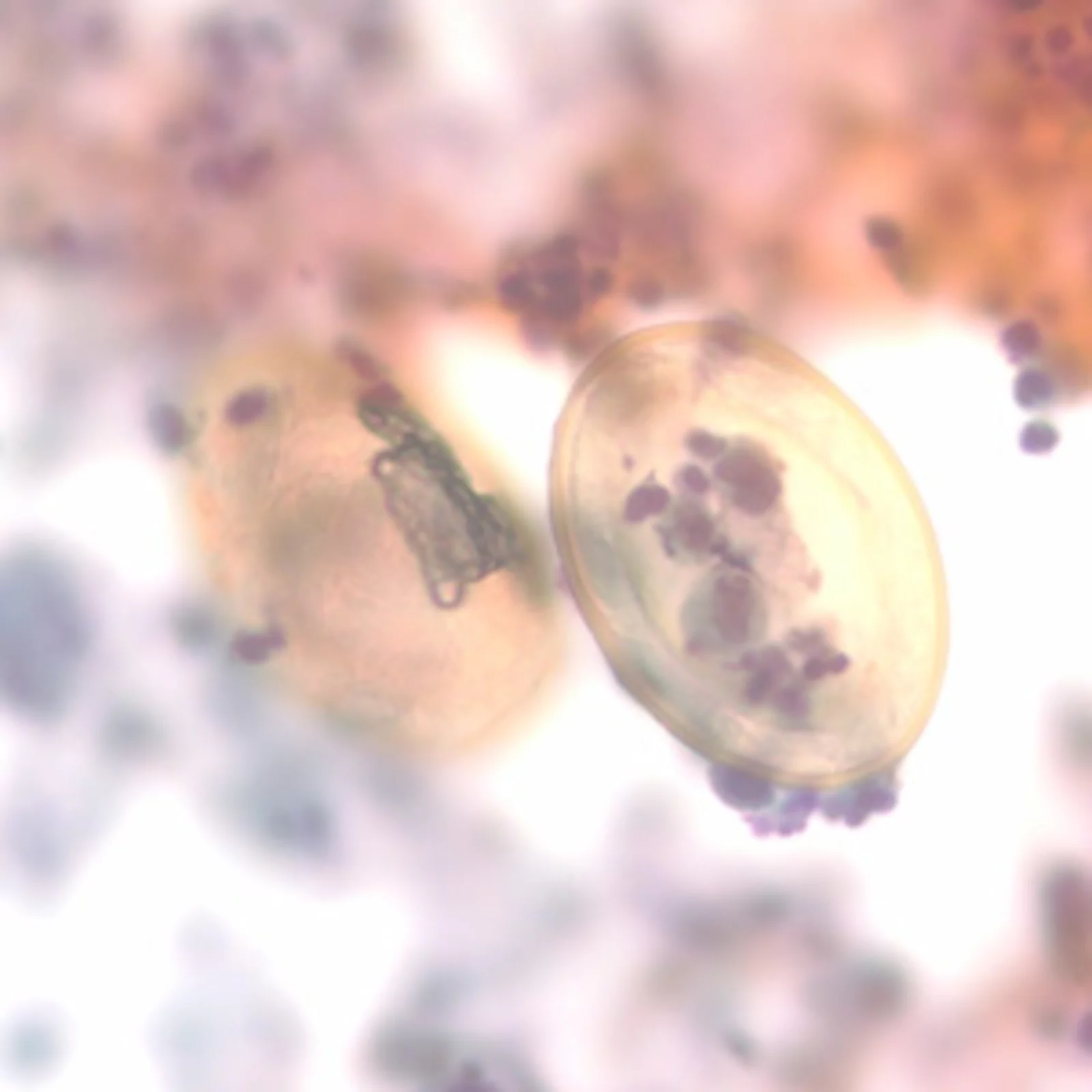 Paragonimus kellicotti eggs in a bronchial alveolar lavage specimen. Source: CDC DPDx. Courtesy of Dr Gary Procop.