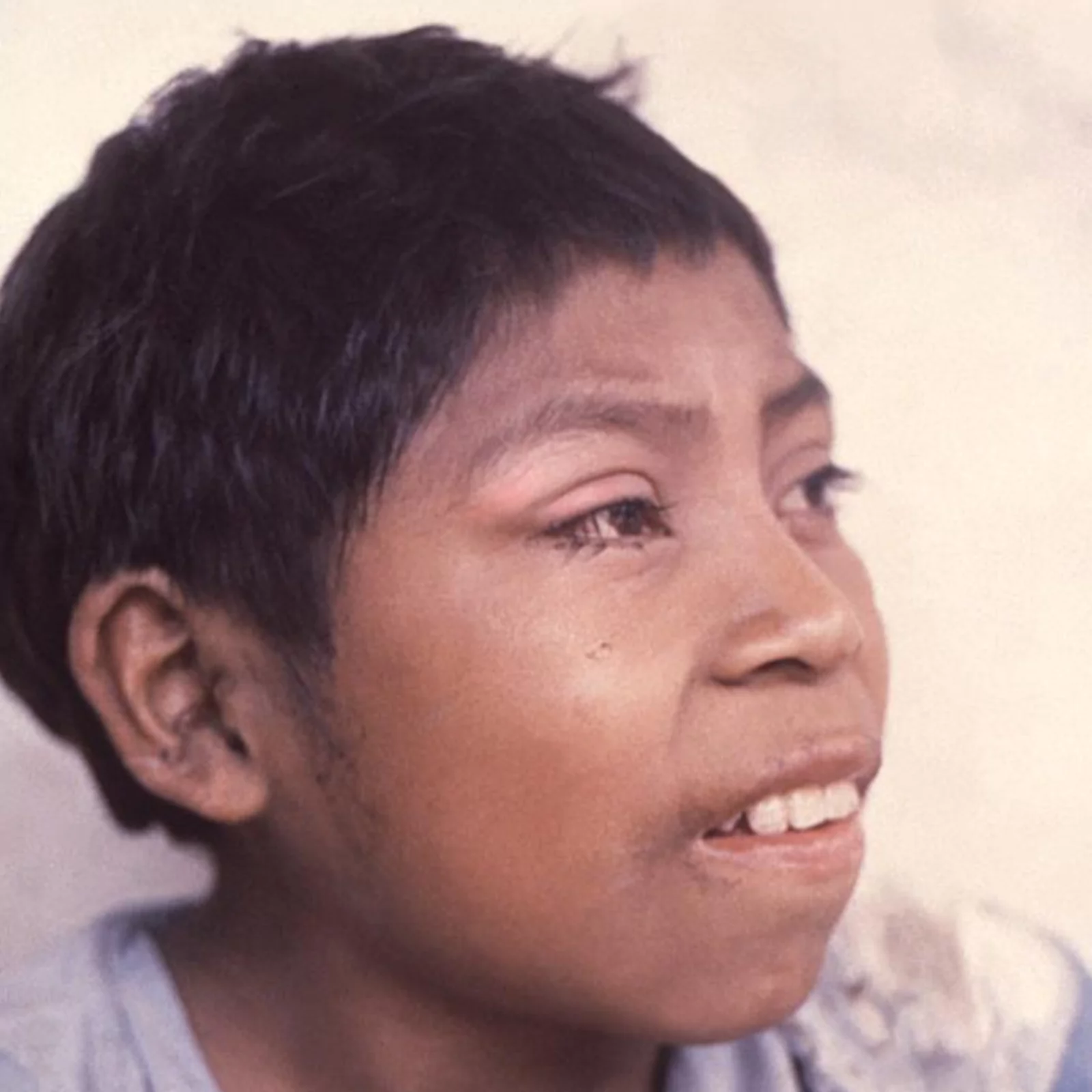 Romaña’s sign in acute Chagas disease. CDC / Dr Mae Melvin, PHIL #15815, 1962. Public domain.